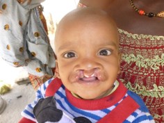 Amadou BAH preop (6) (Small)