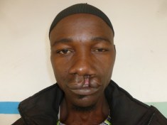 Etienne CAMARA preop (Small)